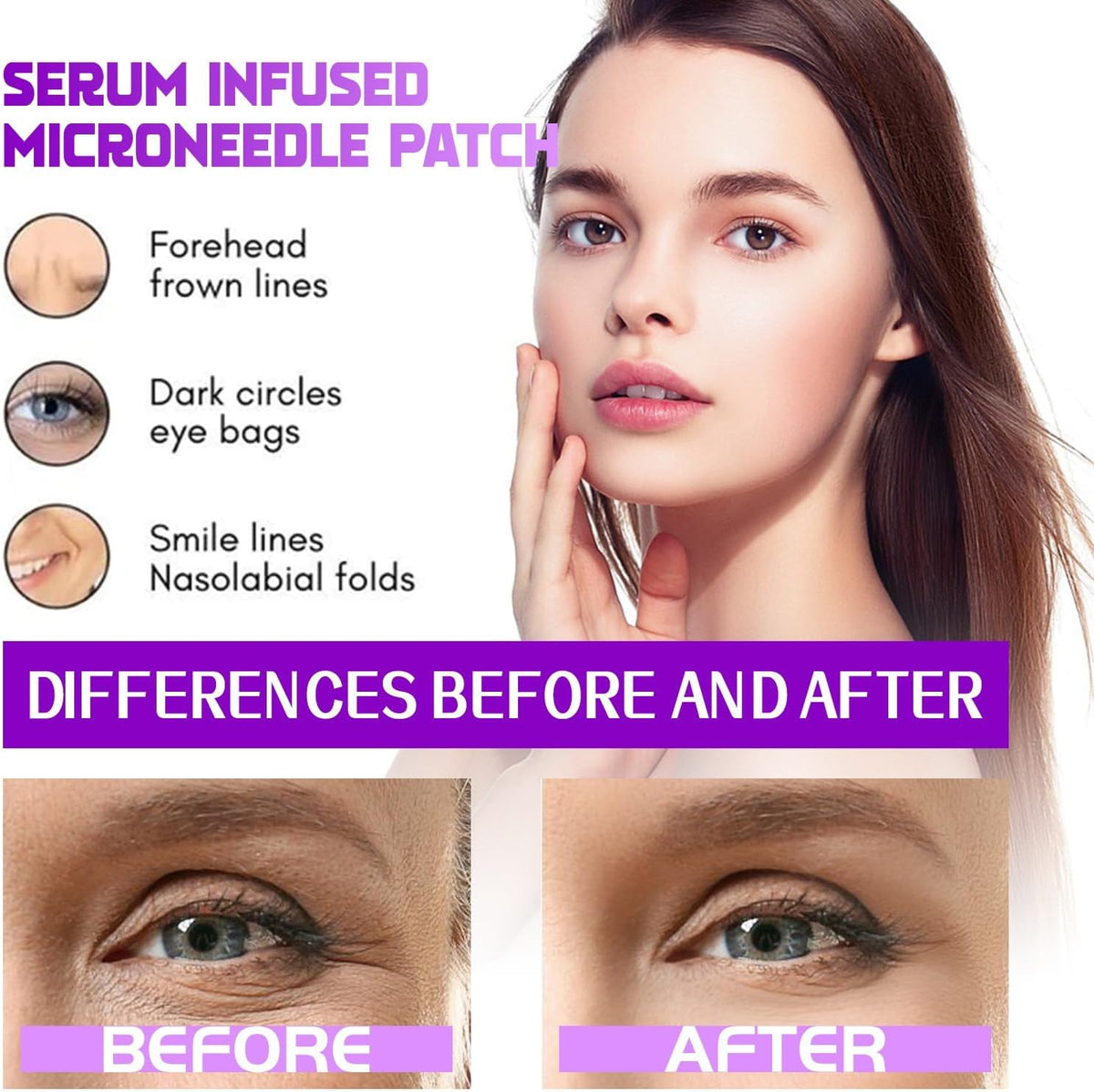 Dissolving Microneedle Eye Patches