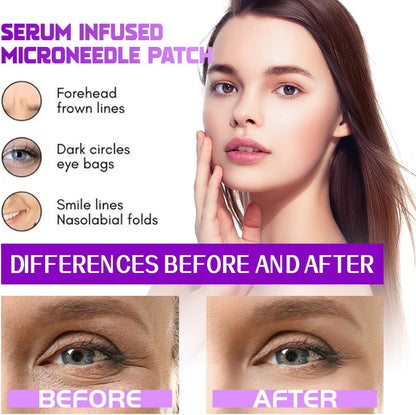 Dissolving Microneedle Eye Patches
