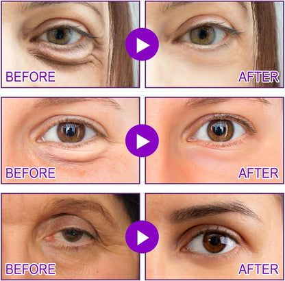 Dissolving Microneedle Eye Patches